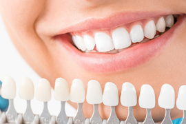 Dental Veneers 