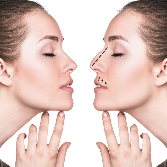 Rhinoplasty (Nose Aesthetics)