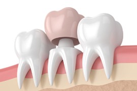 Dental Crown