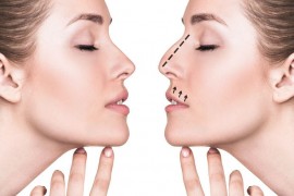 Rhinoplasty (Nose Aesthetics)